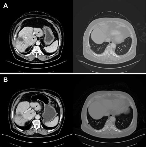 Figure From Oncotargets And Therapy Dovepress Dovepress Folfiri And