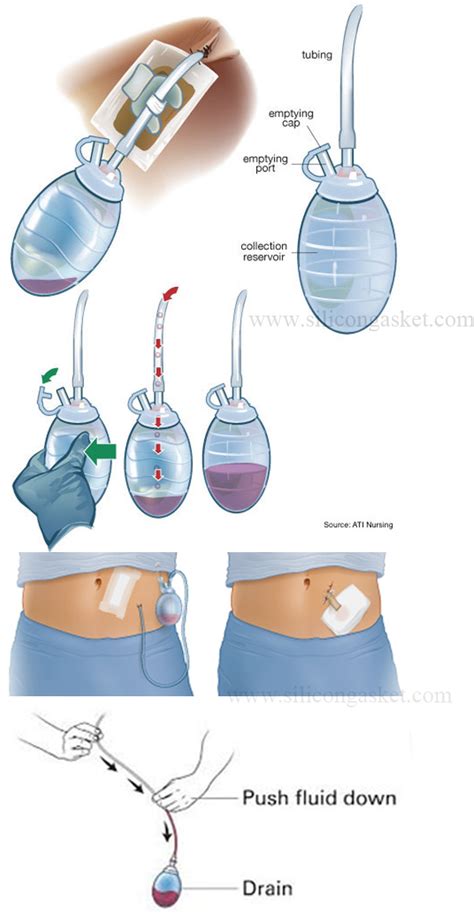 Bulb Type Surgical Drain Medical Drainage Silicone Bulb From China