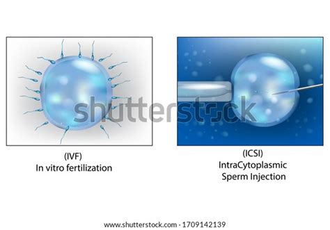 Injection Intra Cytoplasmique De Spermatozoïde Photos and Images