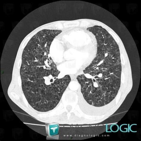 Radiology case : Langerhans cell histiocytosis (CT) - Diagnologic