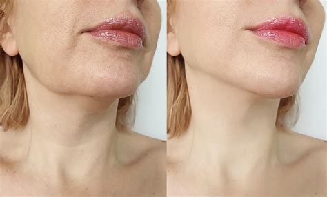 Jawline Sculpting Celeste Medical