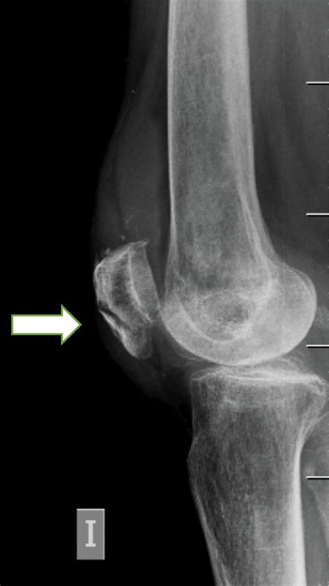 Pasivo La Playa Oveja Radiografia Rotula Cabra Petrificar Optimista