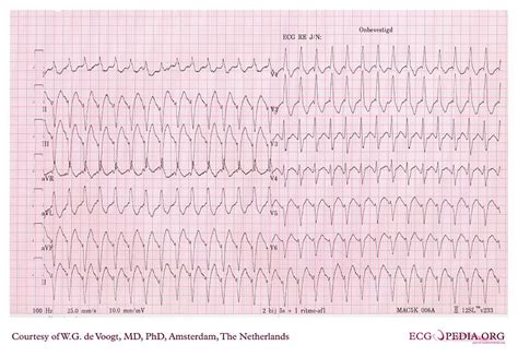 ECG Challenge 42 – How many shockable rhythms can you name? | EMS Student