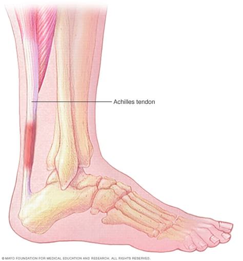 Achilles Tendinitis Symptoms Causes Mayo Clinic