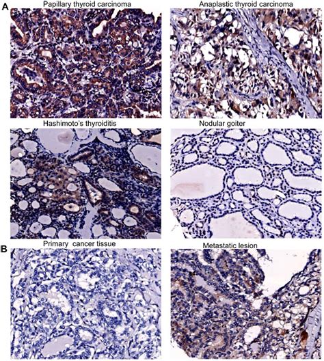 Immunohistochemical Staining Of Cxcr Of Thyroid Tissue Specimens A