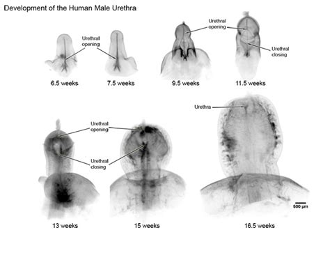 Society For Pediatric Urology The Double Zipper Theory Of Male Anterior Urethra Development