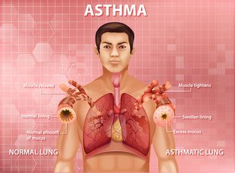 Human Anatomy Asthma Inflamed Bronchial Tube Vector Image