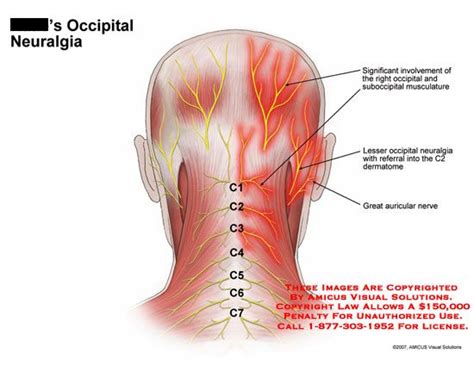 Related image | Occipital neuralgia, Neuralgia symptoms, Neuralgia