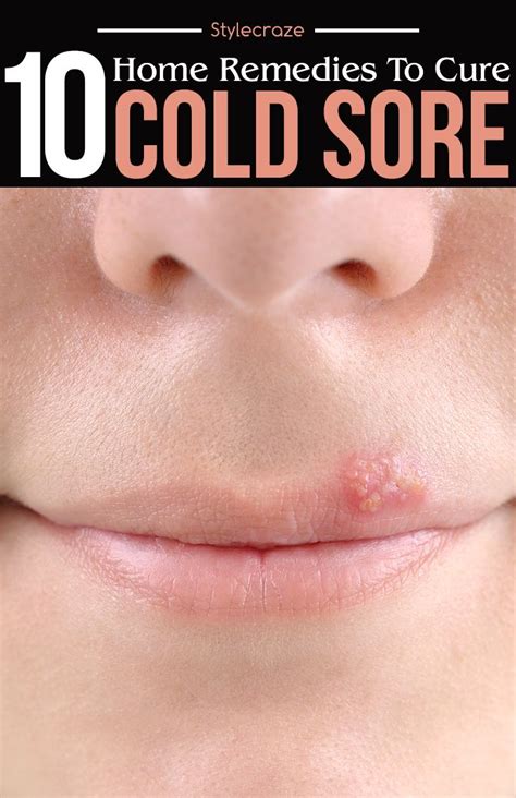 How To Get Rid Of Cold Sores 19 Ways Cold Sore Treatment Cold Sore