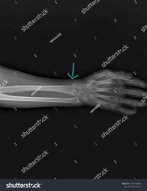 Radiography Forearm Wrist Bones Fracture Distal Stock Photo 1582186984