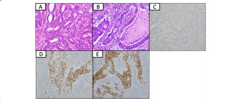 Histopathological Examination Demonstrated The Tumor To Be A