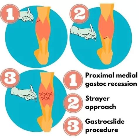 Comprehensive Guide to Plantar Fasciitis Surgery