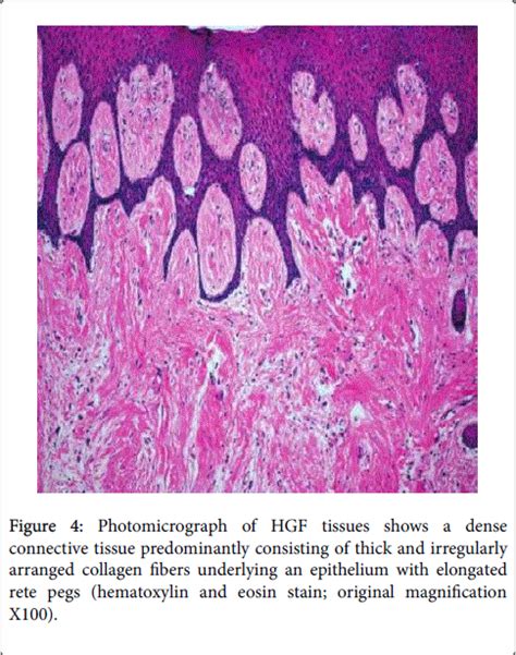 Gingival Hyperplasia Histology