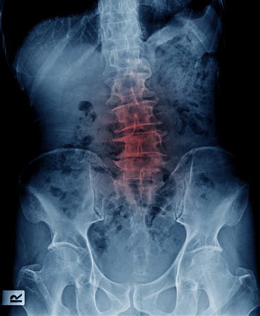 Lumbar Scoliosis And Degenerative Change Stock Photo - Download Image ...