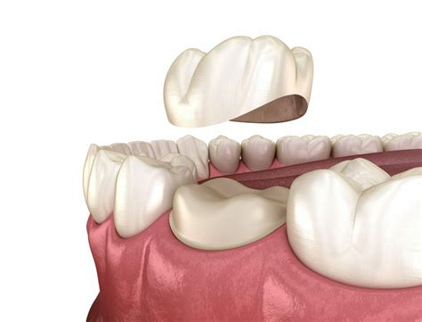 8 Common Dental Crown Problems And Treatment Options