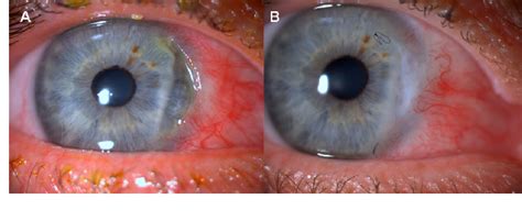 Figure 1 From Update On Peripheral Ulcerative Keratitis Semantic Scholar