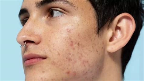 Best Acne Treatment Acne Medication Creams And Pills