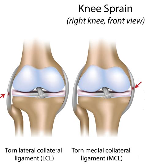 Knee Sprain Treatment Rehab Exercises To Heal Fast And Strong