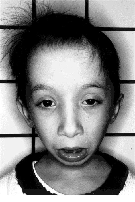 Methotrexate And Pregnancy Birth Defects Pregnancywalls