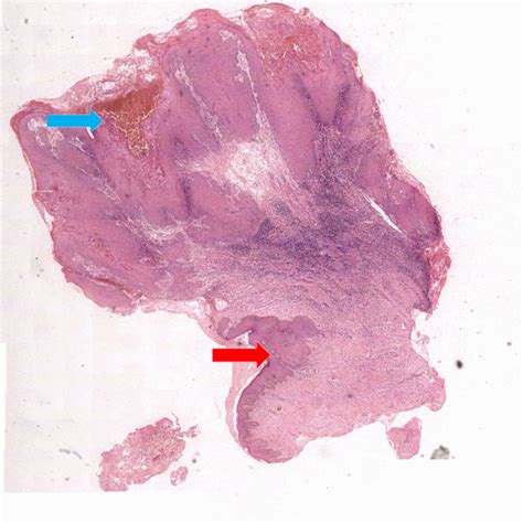 Pseudoepitheliomatous Hyperplasia Harbinger Of Underlying Squamous