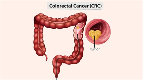 Gastrointestinal Cancers Causes Symptoms Treatments Expert