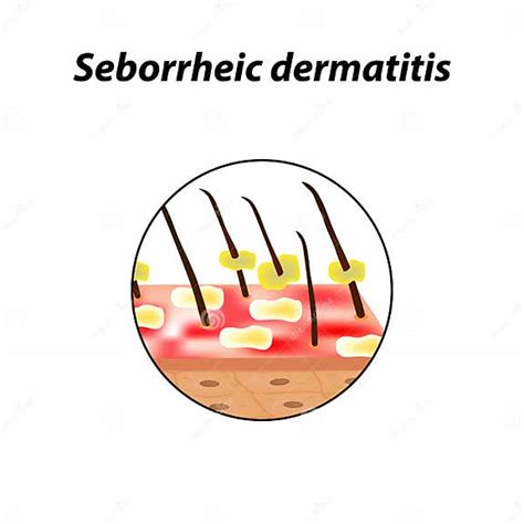 Dermatitis Seborreico De La Piel Y Del Pelo Caspa Seborrhea Calvicie