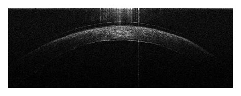 Anterior Segment Optical Coherence Tomography Asoct Images During And Download Scientific