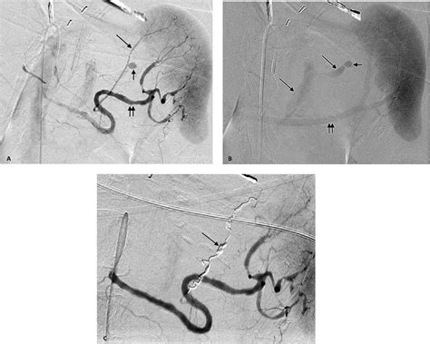 A Digital Subtraction Arteriogram Of A 73 Year Old Female Demonstrates