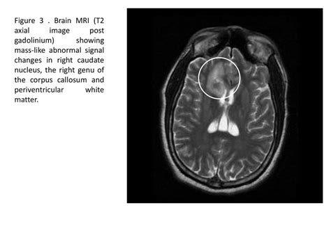 Caudate Nucleus Mri