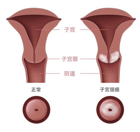 子宫颈癌宫颈癌 体征，诊断，及在新加坡接受治疗 百汇癌症中心马来西亚