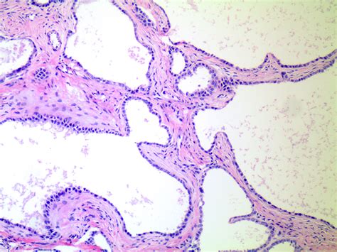 Pathology Outlines Serous Cystadenoma Adenofibroma And Surface Papilloma