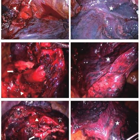 Intraoperative Pictures Of Fissureless Lobectomy For Lung Cancer With