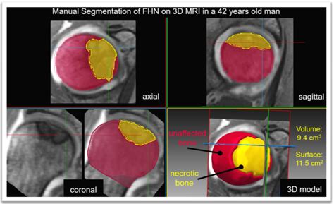 A Deep Learning Method For Quantification Of Femoral Head Necrosis