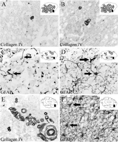 The Cellular And Molecular Composition Of The Scar In Human SCI After