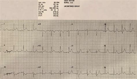 Case 314 Ecg Weekly