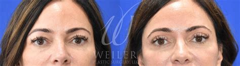 Eyelid Surgery Before And After Pictures Case 943 Baton Rouge New Orleans And Lafayette