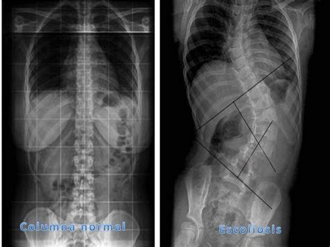 Escoliosis La Escoliosis O Curvatura Anormal De La Columna Vertebral