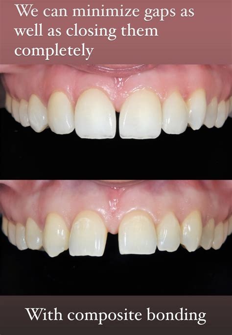 Composite Bonding - Frazer Dental