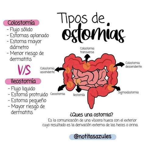 Tipos De Ostomias Yudoc Org Udocz