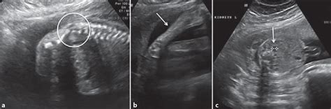 Figure From Prenatal Imaging Of Caudal Regression Syndrome With