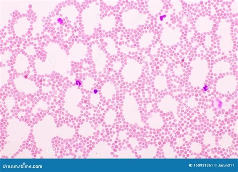 Picture Of White Blood Cell Red Blood Cell And Platelet In Blood Film