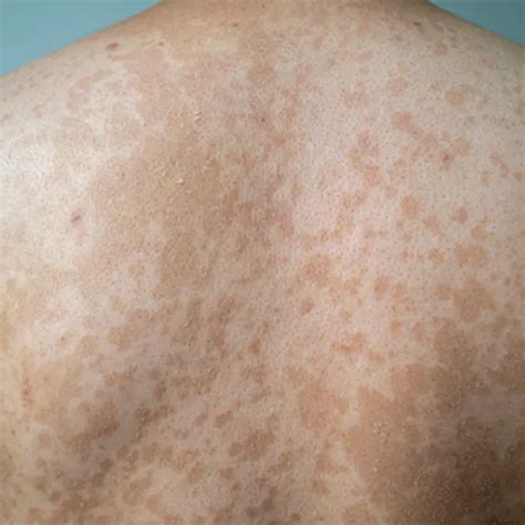 Clear Skin Is Possible Beat Tinea Corporis Ganesh Diagnostic