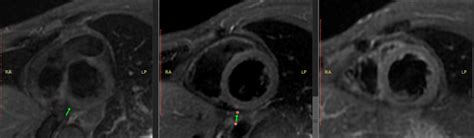 Cardiac MRI With Triple IR Sequencing Showing Hyperintense Signal