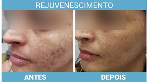 Laser CO2 Fracionado Antes E Depois Veja 16 Fotos Desse Procedimento