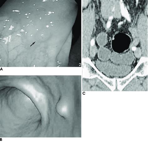 Images in a 56-year-old man with 5-mm polyp in sigmoid colon. A ...