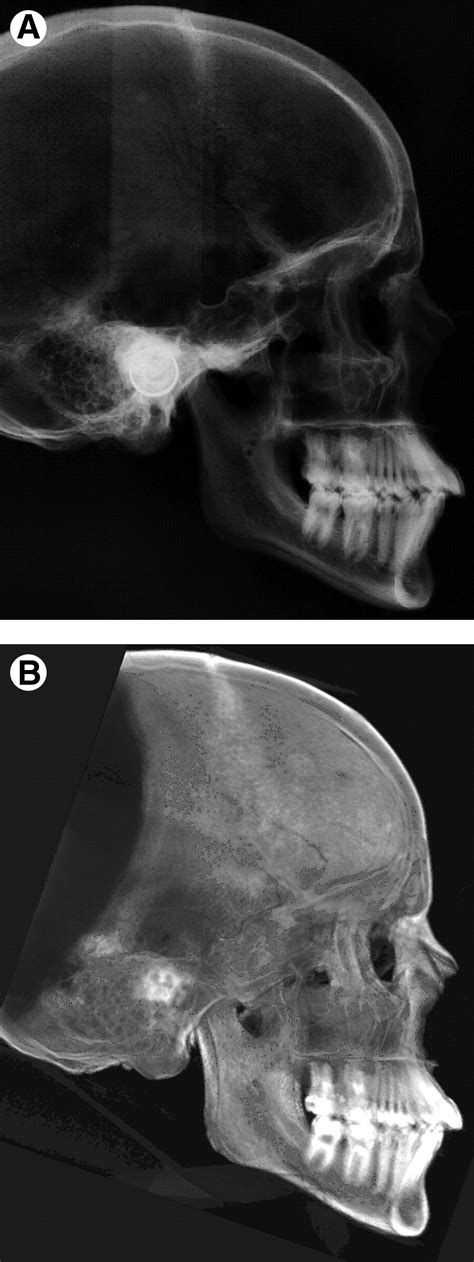 Comparison Of Cephalometric Radiographs Obtained From Cone Beam