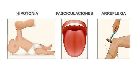 Atrofia Muscular Espinal presente y futuro Neuropediatría y TDAH