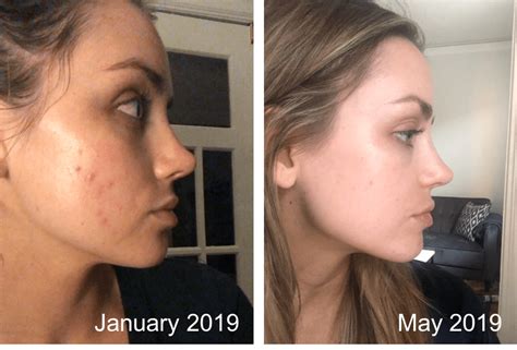 Everything I Did To Heal My Adult Cystic Acne Elyse Wellness