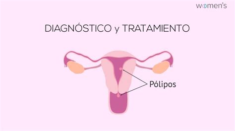 Pólipo endometrial Que es Diagnóstico y tratamiento