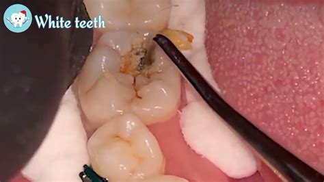 Removing Food Stuck In Tooth Hole Dentist White Teeth YouTube